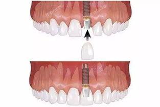 成都種植牙納入醫保了嗎？2025成都種植牙環境好的醫院排名曝光